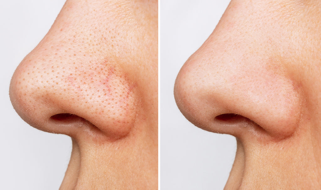CLEAR NOSE Tea Tree Alcohol-Free Acne Gel Concentrate Solution 4g
