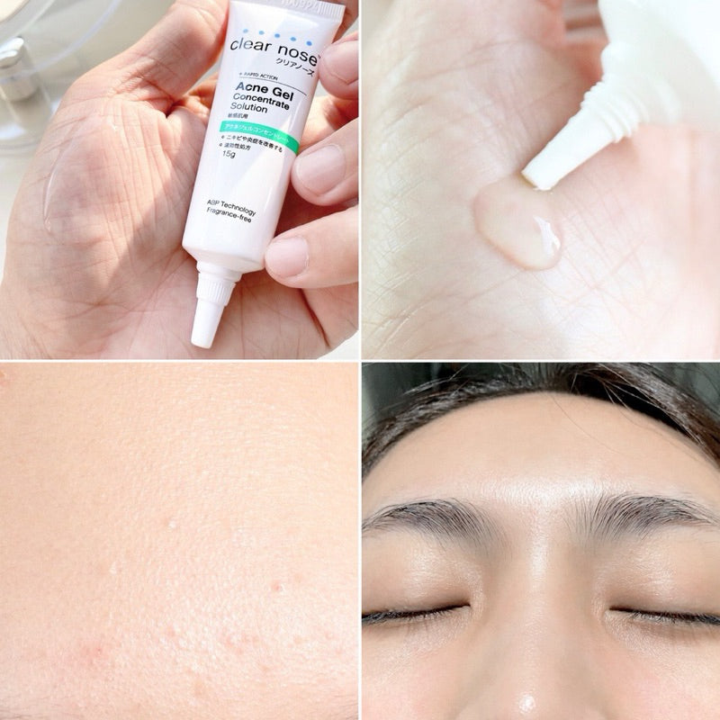 CLEAR NOSE Tea Tree Alcohol-Free Acne Gel Concentrate Solution 4g
